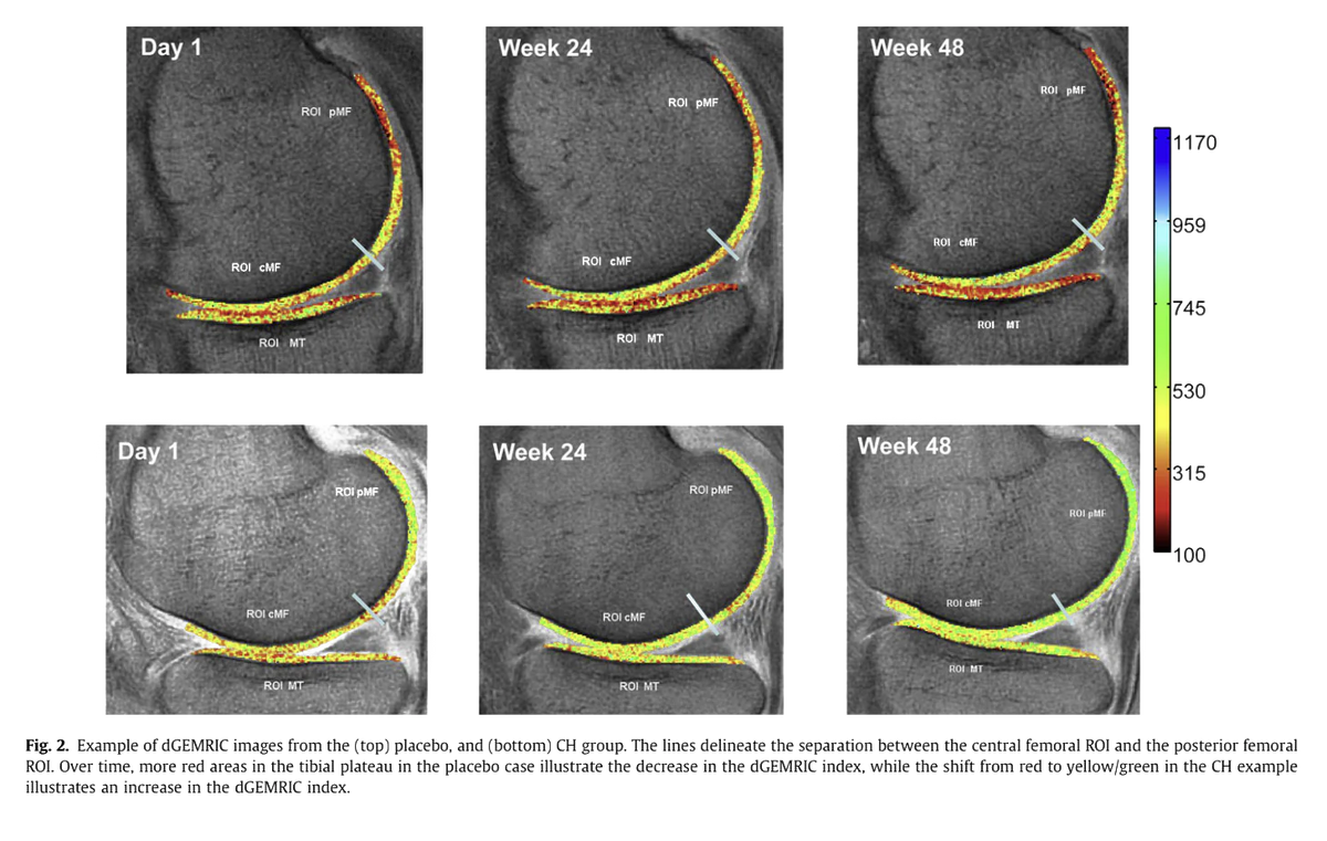 dGEMRIC MRI scans of knee cartilage at day 1, week 24 and week 48, placebo vs collagen peptide group